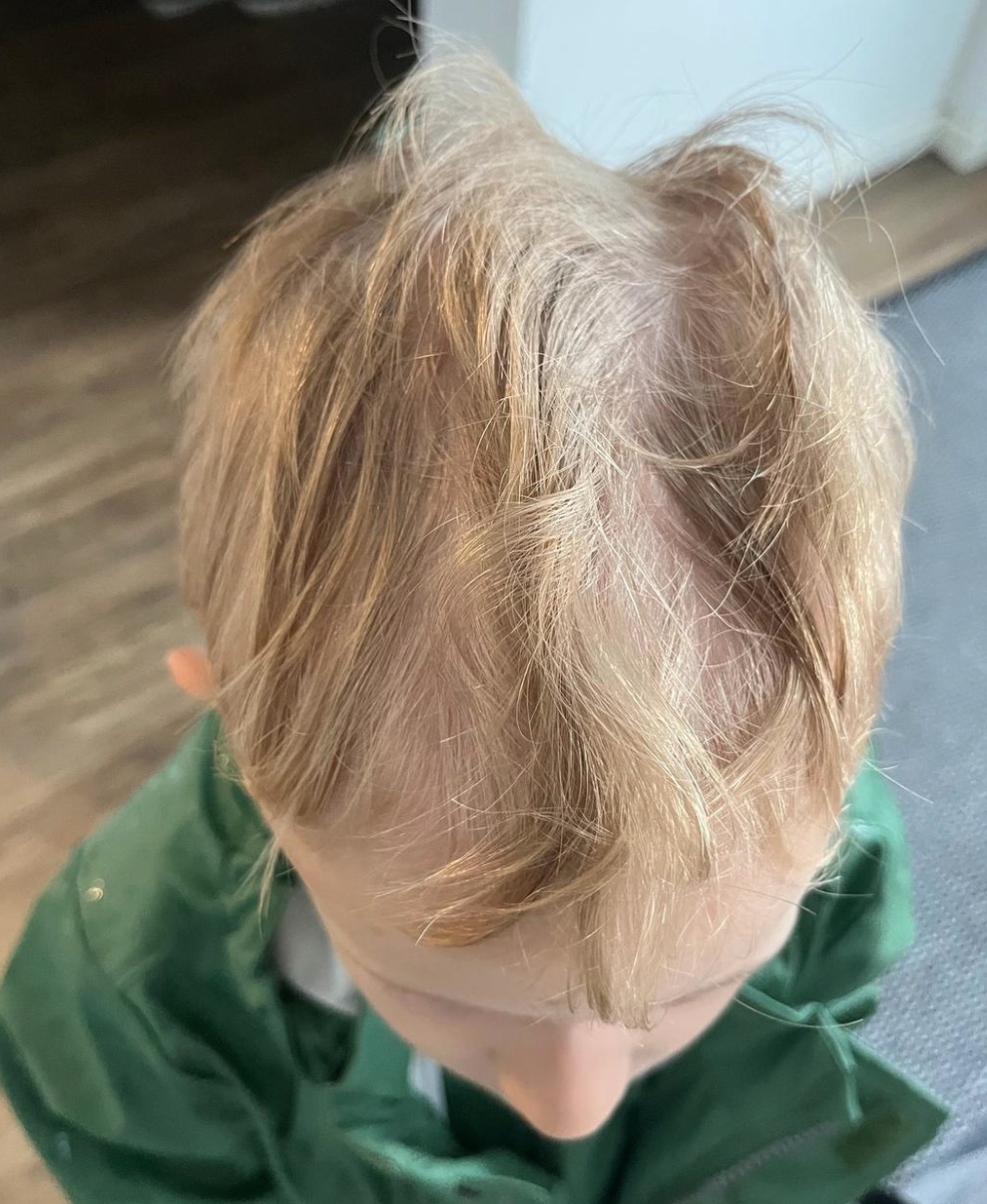 Spuren vom Helm in den Haaren sichtbar